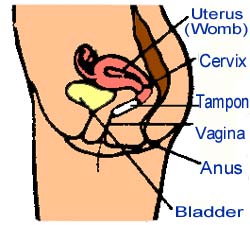 Tampon_in_vagina. Shows position of tampon relative to urethra