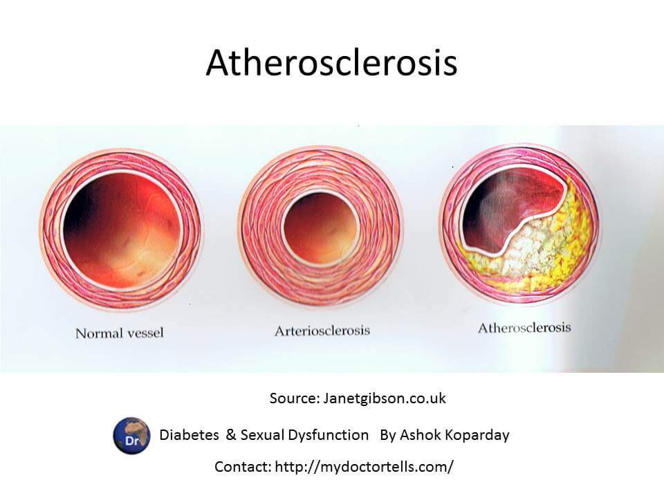 Normal vessel Arteriosclerosis Atherosclerosis Phone‎ 098 67 788877 Best Sexologist Mumbai Ashok Koparday